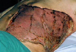 Split thickness skin grafting after surgical debridement