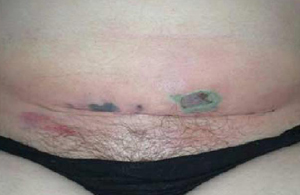 Small areas of skin necrosis in a young woman with cellulitis and necrotizing fasciitis of her lower abdomen 5 days after a cesarean section