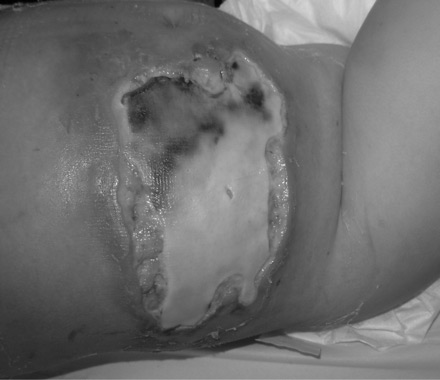 Necrotising fasciitis on the right abdomen of a 2-year old girl following varicella infection