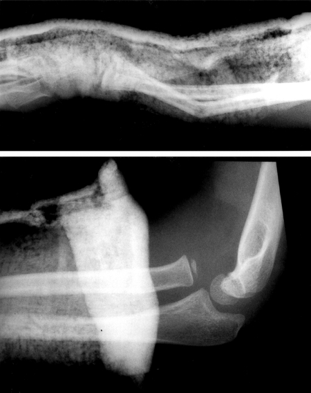 Radiographs showing dislocated radial head with distal third bone forearm fractures