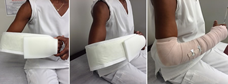 Sugar-tong splint