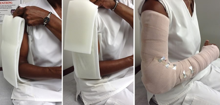 Double sugar-tong splint