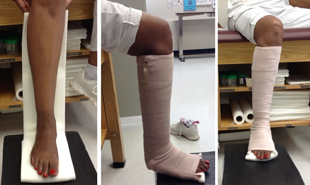 Posterior leg splint