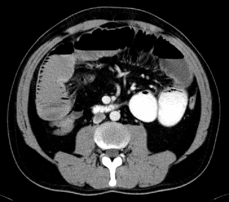 CT scan with intravenous and oral contrast showing fluid-filled small intestine in ileus