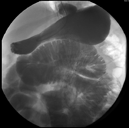 Small bowel series showing dilated small bowel loops in ileus; nasogastric tube is seen curled in the stomach