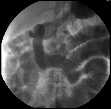 Small bowel series showing dilated contrast-filled small bowel loops in ileus; some contrast is visible in the right colon