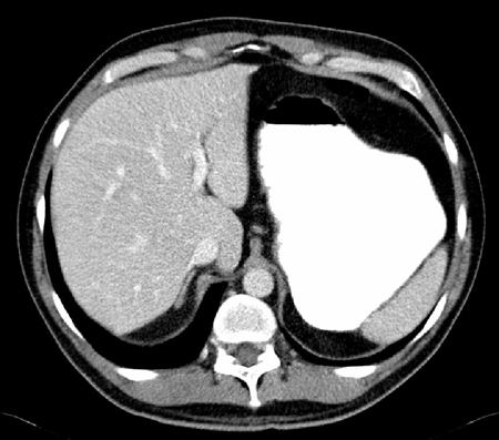 CT scan showing significantly dilated stomach