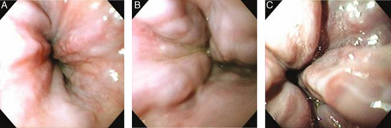 (A) Grade I oesophageal varices. These collapse to inflation of the oesophagus with air. (B) Grade II oesophageal varices. These are varices between grades 1 and 3. (C) Grade III oesophageal varices. These are large enough to occlude the lumen