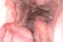 Oesophageal varices images