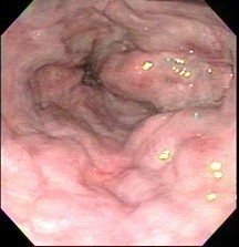 Large oesophageal varices