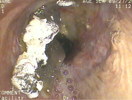 Bronchoscopy showing barium aspiration in a lung transplant patient in the right mainstem bronchus after a barium swallow study