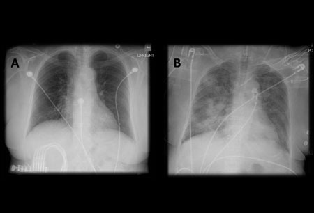 A. Radiografía portátil de tórax en posición erguida antes de la aspiración; B. Radiografía de tórax 1 hora después de la aspiración, en la que se muestran infiltrados alveolares difusos bilaterales, peores en las bases del lado derecho