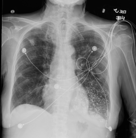 Aspiración de bario. Se produjo una ingesta de bario en una mujer de 53 años. Las imágenes revelaron material hiperdenso centrado en la vía respiratoria en el lóbulo inferior izquierdo compatible con bronquiolitis por aspiración de bario. Se confirmó una fístula traqueoesofágica