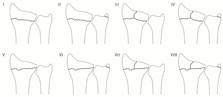 Frykman’s 1967 classification (I: extra-articular; II: as I with fracture of the distal ulna; III: radiocarpal joint involved; IV: as III with fracture of the distal ulna; V: distal radioulnar joint involved; VI: as V with fracture of the distal ulna; VII: radiocarpal and distal radioulnar joints both involved; VIII: as VII with fracture of the distal ulna)