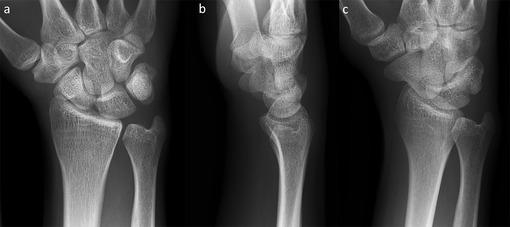 (a) Posteroanterior view, (b) lateral view, and (c) posteroanterior oblique view of a normal right wrist