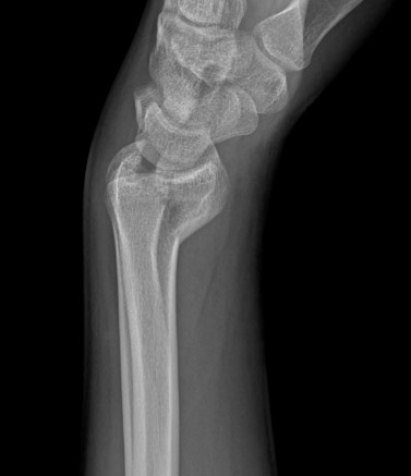 Type B (simple) intra-articular fracture of the distal radius: lateral view