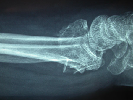 Type C (complex) intra-articular fracture of the distal radius: lateral view