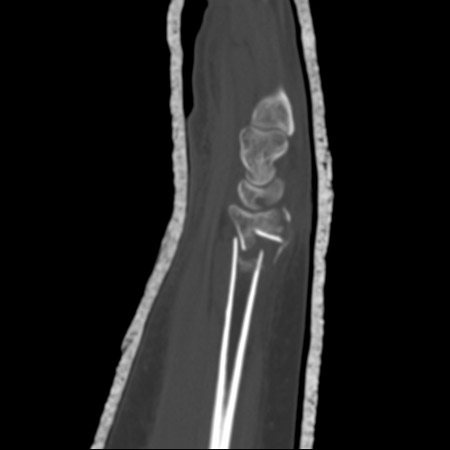 CT scans of the wrist provide excellent detail to assess fracture geometry, articular involvement, as well as degree of comminution