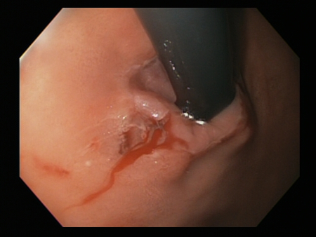 Bleeding Mallory Weiss Tear viewed on retroflexion