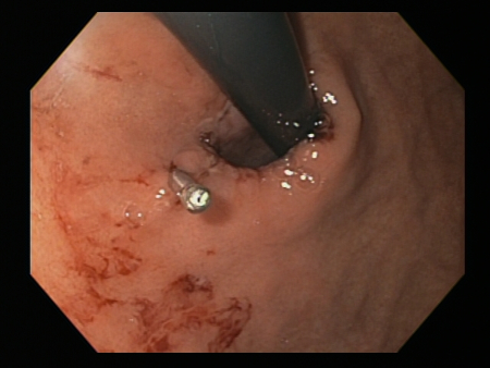 Mallory Weiss tear after application of through-the-scope clip results in haemostasis