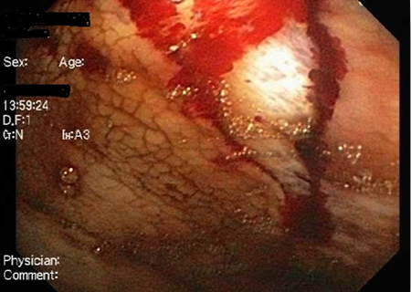56-year-old female had a gastroscopy for upper GI bleeding 5 days prior treated with a single clip. She continued having melaena and low Hb for the following 5 days after initial procedure. A second gastroscopy detected a longitudinal gastric laceration without perforation on the corpus to cardia