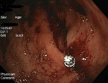 Diagnosed as a gastric tear without perforation from previous gastroscopy evaluation. Managed with application of haemoclips and emergency surgical consult