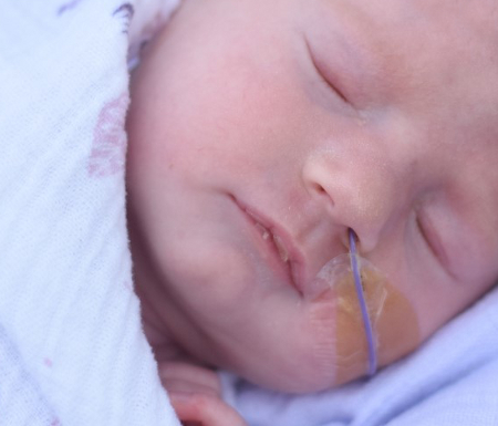 Prader-Willi syndrome images