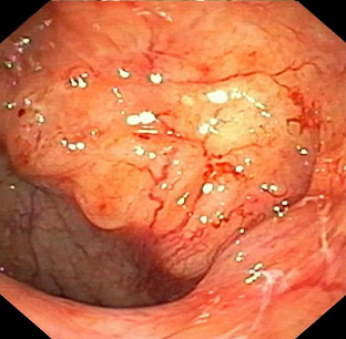 Nasopharyngeal cancer images