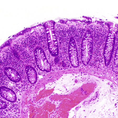 Microscopic colitis images
