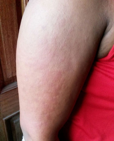 Adult-onset Still disease images