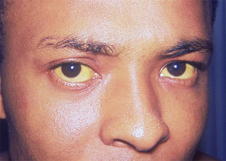 Hepatitis D images