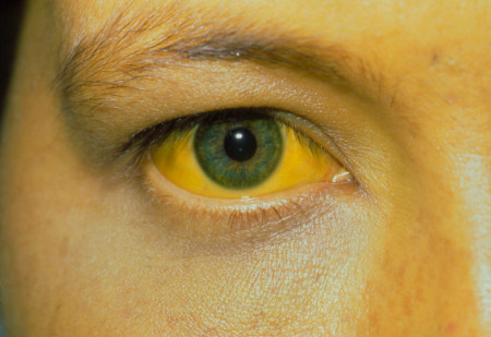 Hepatitis E images
