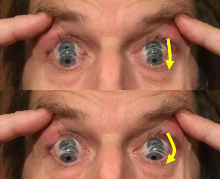 Progressive supranuclear palsy images
