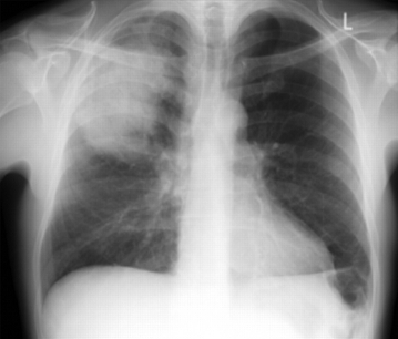 Posterior-anterior chest radiograph showing right upper lobe consolidation in a patient with community-acquired pneumonia
