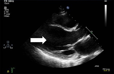 Systolic image of dilated left ventricle (arrow); note there is no change from diastolic image
