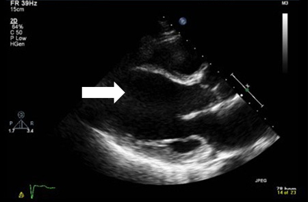 Diastolic image of dilated left ventricle (arrow)