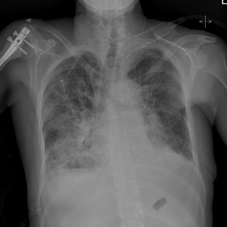 Chest x-ray of acute pulmonary edema showing increased alveolar markings and bilateral pleural effusions