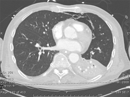 CT scan of a patient with a large, dense left lower lobe infiltrate