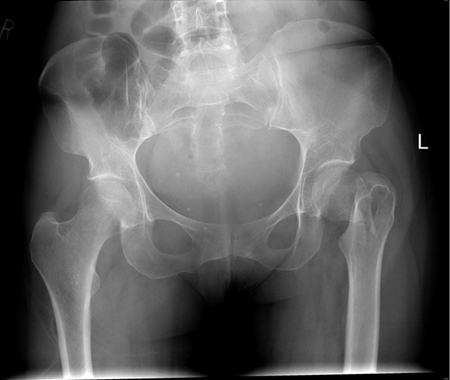 Initial anteroposterior radiograph showing a displaced left hip intracapsular fracture