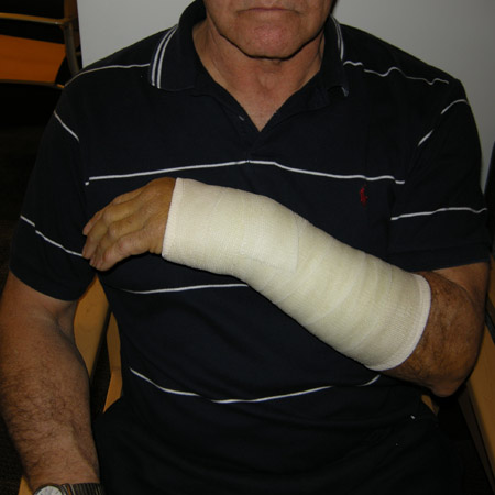 Cast treatment of a distal radius fracture