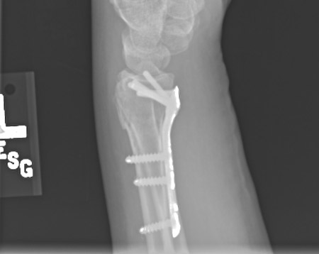 Plate fixation after open reduction with a volarly placed plate and screws