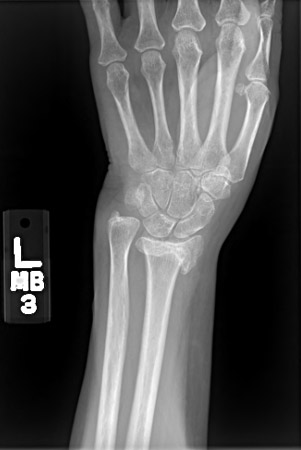 Posteroanterior radiograph showing malunion of the distal radius with significant shortening of the radius and relative lengthening of the ulna