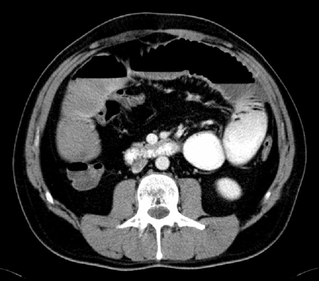 CT scan with intravenous and oral contrast showing fluid-filled small intestine and cecum in ileus