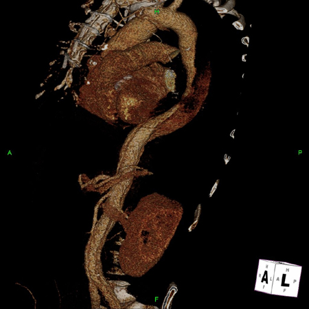 3D CT, distal dissection