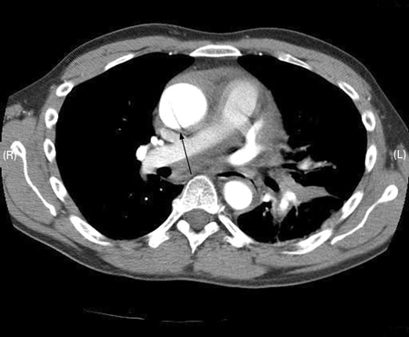 CT scan showing dissecting aneurysm in a 45-year-old patient with Marfan syndrome experiencing chest pain