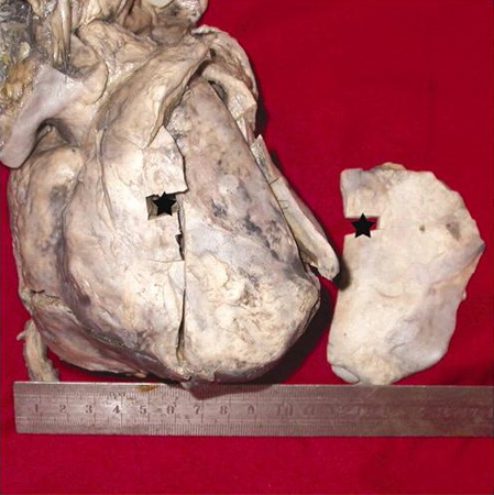 Constrictive pericarditis identified at autopsy; the right section is scar tissue cut from the very front of the heart