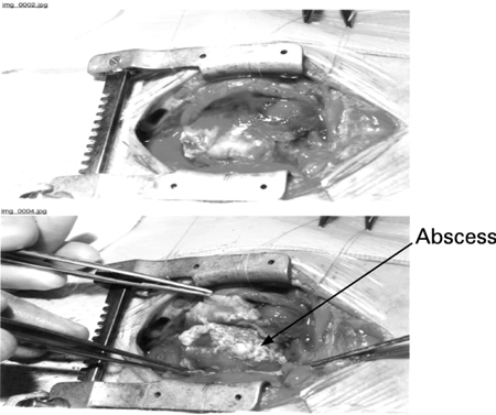 Open surgery in a baby with purulent pericarditis; the abscess is indicated by the arrow