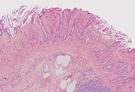 Histopathology of intestinal ischemia