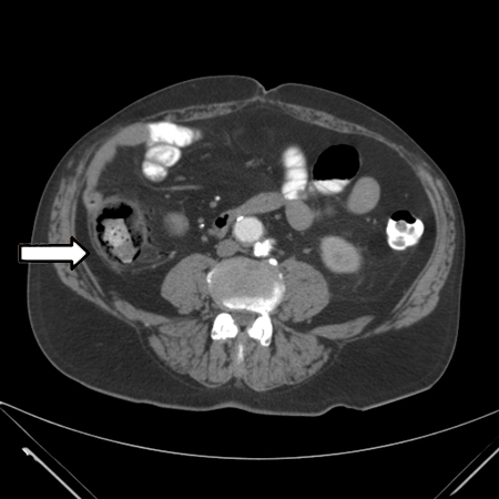 CT scan: colonic thickening with pneumatosis intestinalis