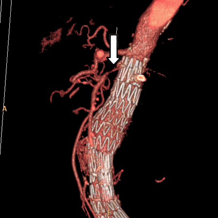 CT angiography: 3-dimensional reconstruction with superior mesenteric artery stenosis from severe atherosclerotic plaque in a patient on follow-up imaging for endovascular aneurysm repair
